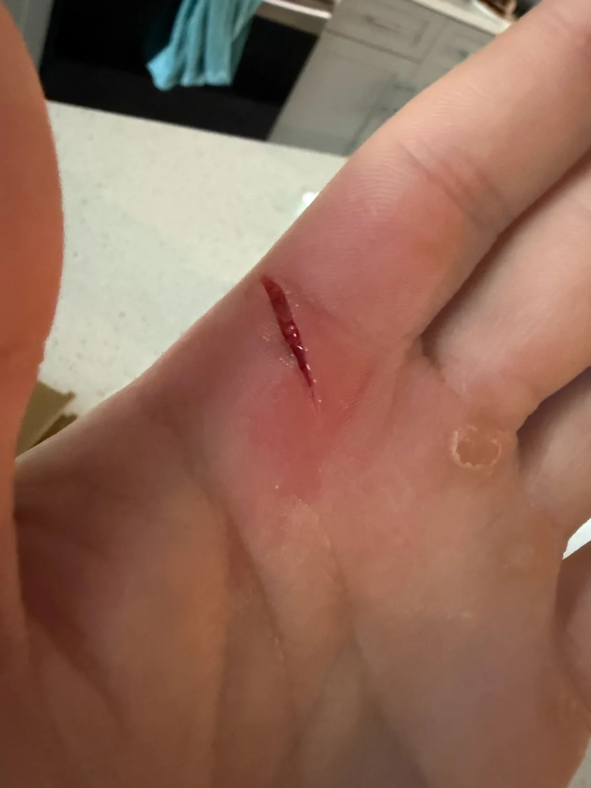 I Cut My Finger at Home: Do I Need Stitches?